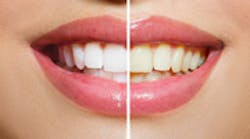 Content Dam De Print Articles Volume 105 Issue 1 Teeth Whitening Thumbnail Content Dam De Print Articles Volume 105 Issue 1 Teeth Whitening Thumbnail