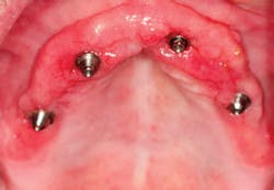 1404demas01 Inflamed Tissue 1404demas01 Inflamed Tissue