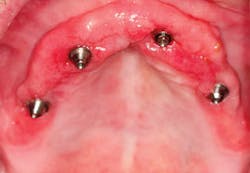 1404demas01 Inflamed Tissue 1404demas01 Inflamed Tissue