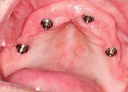 1404demas02 Healed Tissue 1404demas02 Healed Tissue