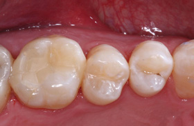 dental resin