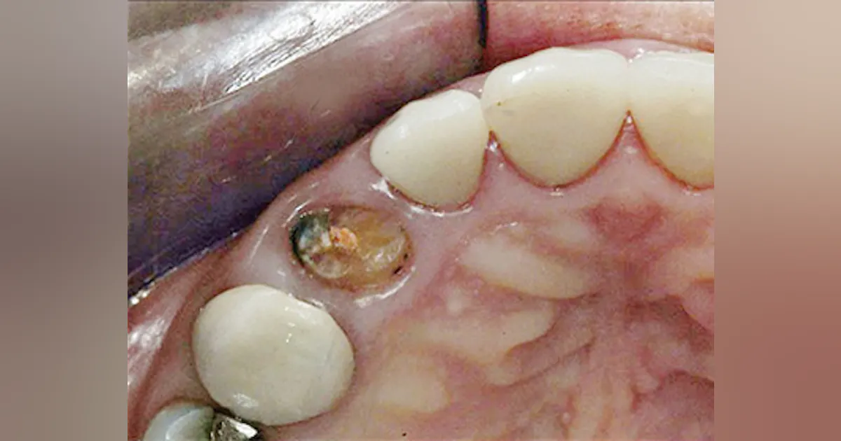 Tooth Retention Implant placement vs. tooth retention | Dental Economics