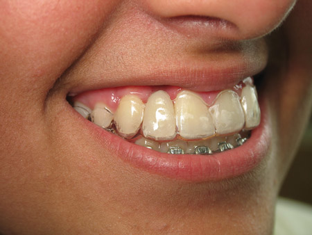 Can You Eat With Flipper Teeth Teethwalls