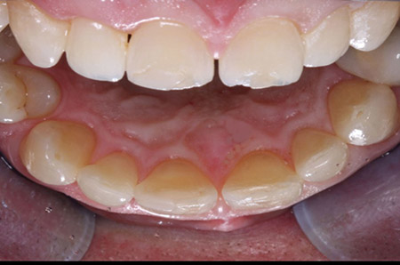 Crowns Versus Veneers Dental Economics