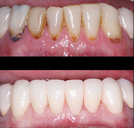 picture Pfm Crowns Vs Zirconia zirconia and lithium disilicate