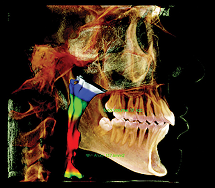 Airway