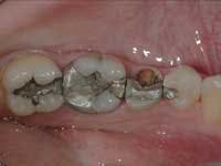 Figure 1: Premolar tooth with minimal tooth structure remaining requires a post and pins to ensure connection of the coronal build-up to the remaining root structure. Figure 1: Premolar tooth with minimal tooth structure remaining requires a post and pins to ensure connection of the coronal build-up to the remaining root structure.