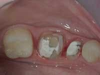 Figure 2: A fiber-reinforced resin-based composite post and two pure titanium pins (Filpins) have been placed in the premolar shown in Fig. 1 to ensure retention of the build-up material. Figure 2: A fiber-reinforced resin-based composite post and two pure titanium pins (Filpins) have been placed in the premolar shown in Fig. 1 to ensure retention of the build-up material.