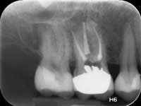 Figure 3: Radiograph from endodontist showing well done endodontic treatment, but minimal tooth structure remaining.