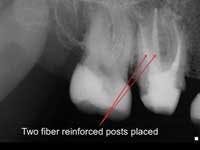 Figure 4: Tooth shown in figure 3 was built up with two fiber-reinforced resin-based composite posts and bonded composite.