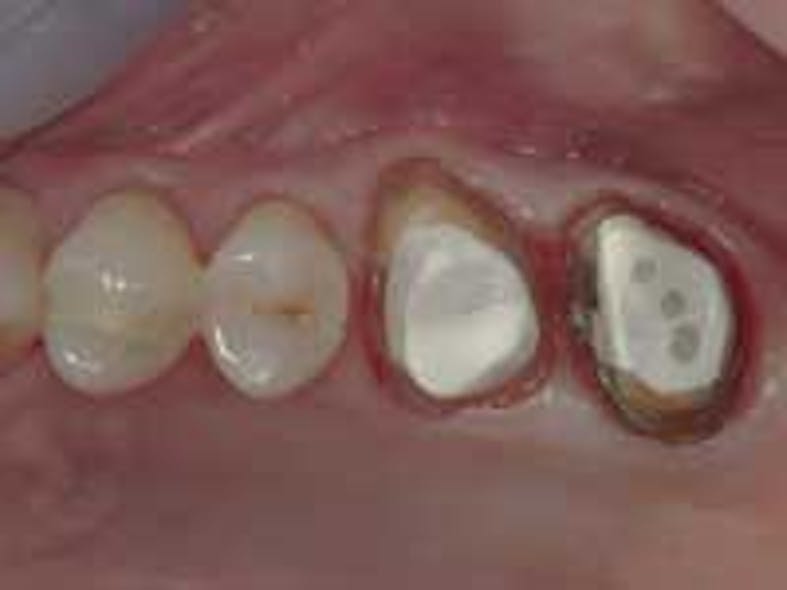 Figure 5: Often, endodontically treated teeth with minimal tooth structure remaining, such as the second molar shown, can be built up adequately to provide long-term service.