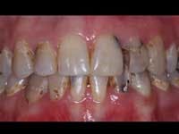 Figure 6: Preoperative view of patient with gross caries in both maxillary and mandibular anterior teeth. Several of the teeth were treated endodontically and posts, build-ups, and tooth-colored crowns were placed on the teeth. Assuming adequate oral hygiene is practiced, teeth restored in such manner will serve for many years. Figure 6: Preoperative view of patient with gross caries in both maxillary and mandibular anterior teeth. Several of the teeth were treated endodontically and posts, build-ups, and tooth-colored crowns were placed on the teeth. Assuming adequate oral hygiene is practiced, teeth restored in such manner will serve for many years.