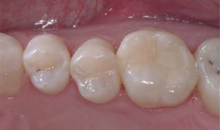 What causes changes in occlusion? | Dental Economics