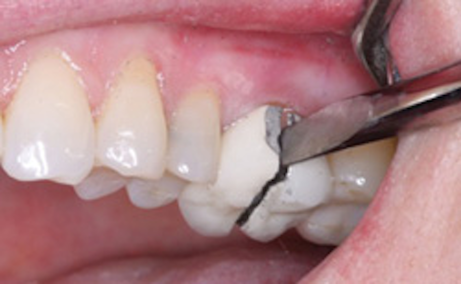Laser vs. electrosurgery for soft tissue cutting Dental Economics