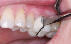 Figure 1: Broken connector on zirconia-based, multiple-unit fixed prosthesis in CR TRAC Research long-term study. Use wide connectors for zirconia restorations.
