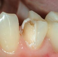 Figure 2: Two full-zirconia, three-unit restorations replacing both first molars demonstrate the esthetic characteristics of full-zirconia restorations at the time of this publication.