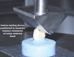 Figure 4: Tooth buildups were placed and retentive tooth preparations made.