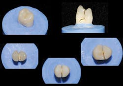 Figure 5: Cast-gold alloy restorations were placed on molars for this bruxing patient as a precaution, lithium disilicate restorations were placed on the remainder of the teeth, and an occlusal nightguard was made for use every night.