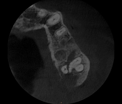 CBCT scan verifies palatal root fracture prior to proposed sinus lift