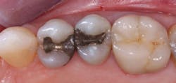 Figure 1: Amalgams that have served many years planned to be replaced with a tooth-colored restoration at the patient&apos;s request. Most such restorations had no bonding and served well in spite of the lack of bond. However, bonding to tooth structure is now considered to be desirable if not mandatory.