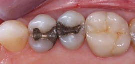 Figure 1: Amalgams that have served many years planned to be replaced with a tooth-colored restoration at the patient&apos;s request. Most such restorations had no bonding and served well in spite of the lack of bond. However, bonding to tooth structure is now considered to be desirable if not mandatory.