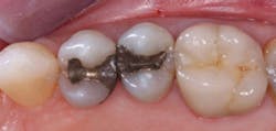 Figure 1: Amalgams that have served many years planned to be replaced with a tooth-colored restoration at the patient's request. Most such restorations had no bonding and served well in spite of the lack of bond. However, bonding to tooth structure is now considered to be desirable if not mandatory. Figure 1: Amalgams that have served many years planned to be replaced with a tooth-colored restoration at the patient's request. Most such restorations had no bonding and served well in spite of the lack of bond. However, bonding to tooth structure is now considered to be desirable if not mandatory.