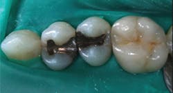 Figure 2: When using the bonding methods to be described, a clean and dry field is necessary. Rubber dam is still the most adequate method to produce a noncontaminated operating field. Figure 2: When using the bonding methods to be described, a clean and dry field is necessary. Rubber dam is still the most adequate method to produce a noncontaminated operating field.