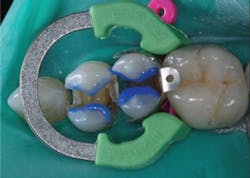 Figure 3: Many dentists prefer to etch enamel only, avoiding opening the dentinal canals and reducing the chance of postoperative tooth sensitivity. Figure 3: Many dentists prefer to etch enamel only, avoiding opening the dentinal canals and reducing the chance of postoperative tooth sensitivity.