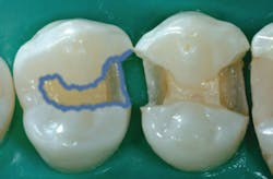 Figure 4: The first premolar is undergoing selective etching with a well-controlled acid gel. Many prefer the selective etch technique over total-etch to reduce the possibility of postoperative tooth sensitivity. Measurable bonds of both methods used with current products are similar.