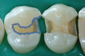 Figure 4: The first premolar is undergoing selective etching with a well-controlled acid gel. Many prefer the selective etch technique over total-etch to reduce the possibility of postoperative tooth sensitivity. Measurable bonds of both methods used with current products are similar.