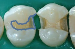 Figure 4: The first premolar is undergoing selective etching with a well-controlled acid gel. Many prefer the selective etch technique over total-etch to reduce the possibility of postoperative tooth sensitivity. Measurable bonds of both methods used with current products are similar. Figure 4: The first premolar is undergoing selective etching with a well-controlled acid gel. Many prefer the selective etch technique over total-etch to reduce the possibility of postoperative tooth sensitivity. Measurable bonds of both methods used with current products are similar.