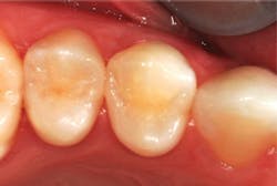 Figure 5: The first premolar requires a minimal DO restoration as observed radiographically, and the second premolar requires a small MOD restoration. Figure 5: The first premolar requires a minimal DO restoration as observed radiographically, and the second premolar requires a small MOD restoration.