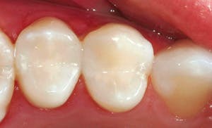 Figure 6: The same teeth as shown in Fig. 5 after bleaching and placement of two restorations. Such small restorations should serve many years, while it has been proven that larger Class II restorations do not serve as well.