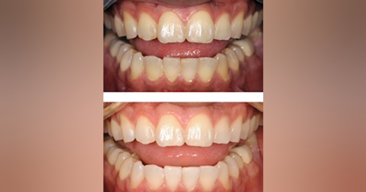 Tooth color modification: A discussion on the mechanism and options for ...