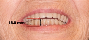Reline Procedure Dental Economics