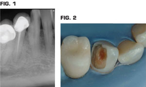 Pulp cap, endodontics, or extract? | Dental Economics Pulp cap, endodontics, or extract? | Dental Economics