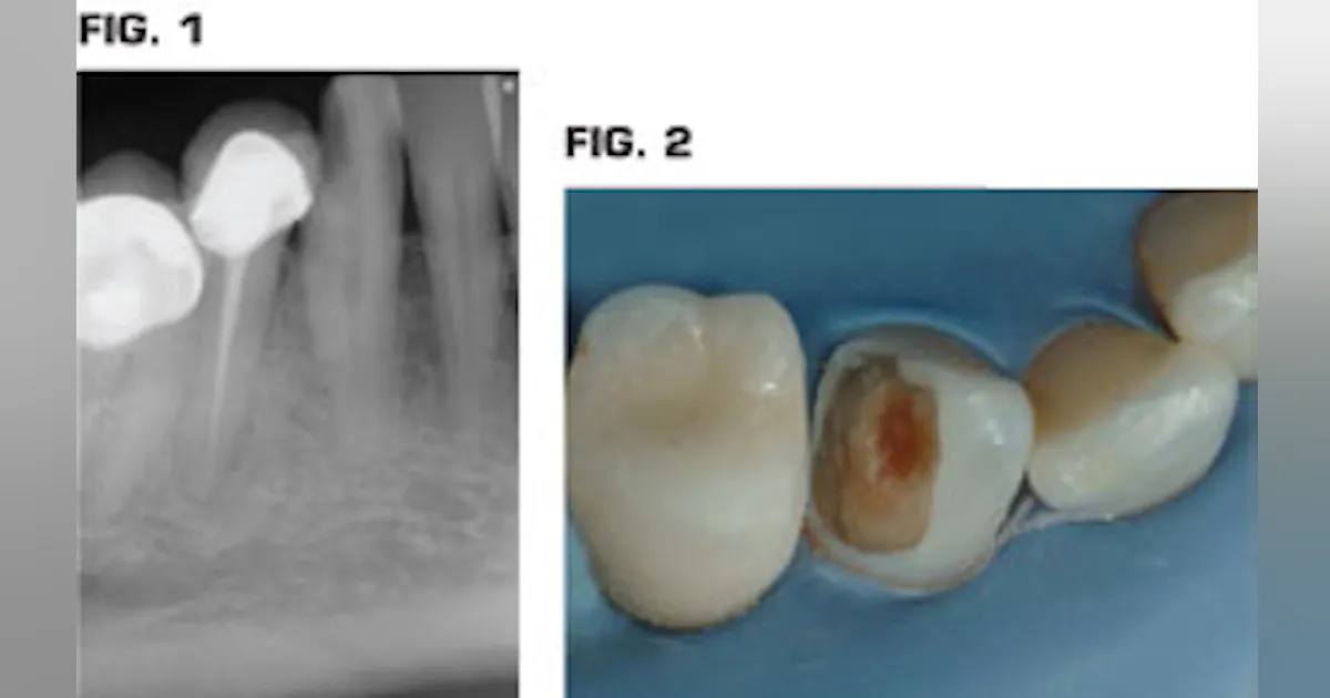 Pulp cap, endodontics, or extract? | Dental Economics