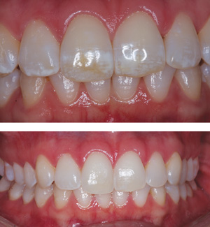 mi paste teeth whitening