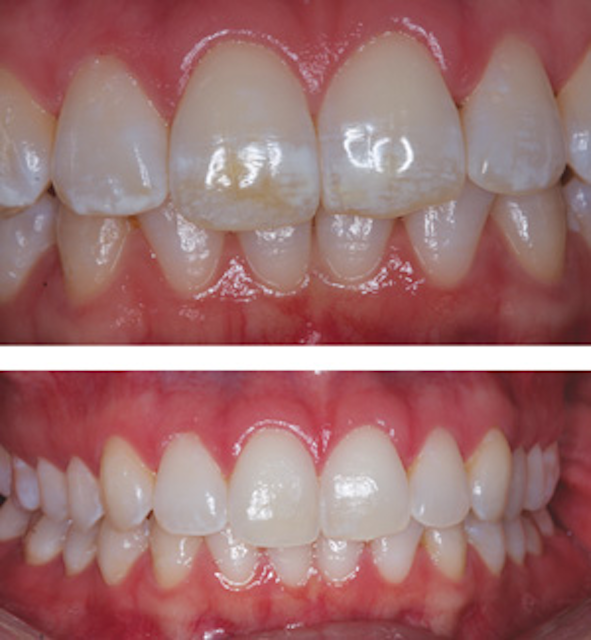 Using Combination Microabrasion, MI Paste, And Whitening To Treat
