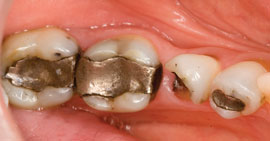 Tired of utilizing cord and paste to manage tissue retraction? Dental