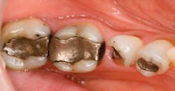 Poss Dr Stehen De April 2014 Fig 1 Before Amalgam And Decay Removed1 Poss Dr Stehen De April 2014 Fig 1 Before Amalgam And Decay Removed1