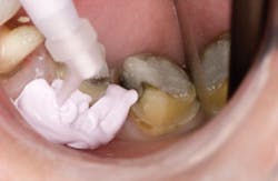 Poss Dr Stephen De April 2014 Feature Fig 3 Aqualsil Cordless Placement1 Poss Dr Stephen De April 2014 Feature Fig 3 Aqualsil Cordless Placement1