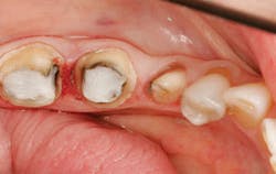 Poss Dr Stephen De April 2014 Fig 2 Crown Preparations Amalgamdecay Removed1 Poss Dr Stephen De April 2014 Fig 2 Crown Preparations Amalgamdecay Removed1