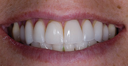 Poss Dr Stephen De March 2013 1 Empress Veneers Placed In 1994