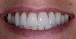 Poss Dr Stephen De March 2013 1 Empress Veneers Placed In 1994 Poss Dr Stephen De March 2013 1 Empress Veneers Placed In 1994