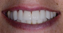 Poss Dr Stephen De March 2013 2 Replacement With Lithium Disilicate Poss Dr Stephen De March 2013 2 Replacement With Lithium Disilicate