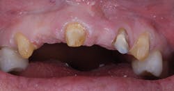 Poss Dr Stephen De March 2013 3 6 Unit Preparation For Zirconia Bridge Poss Dr Stephen De March 2013 3 6 Unit Preparation For Zirconia Bridge