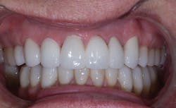 Poss Dr Stephen De March 2013 4 Zirconia Layered 6 Unit Bridge Poss Dr Stephen De March 2013 4 Zirconia Layered 6 Unit Bridge