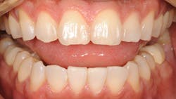 Ringer Drjack De March And April 2012 Image After Ringer Drjack De March And April 2012 Image After