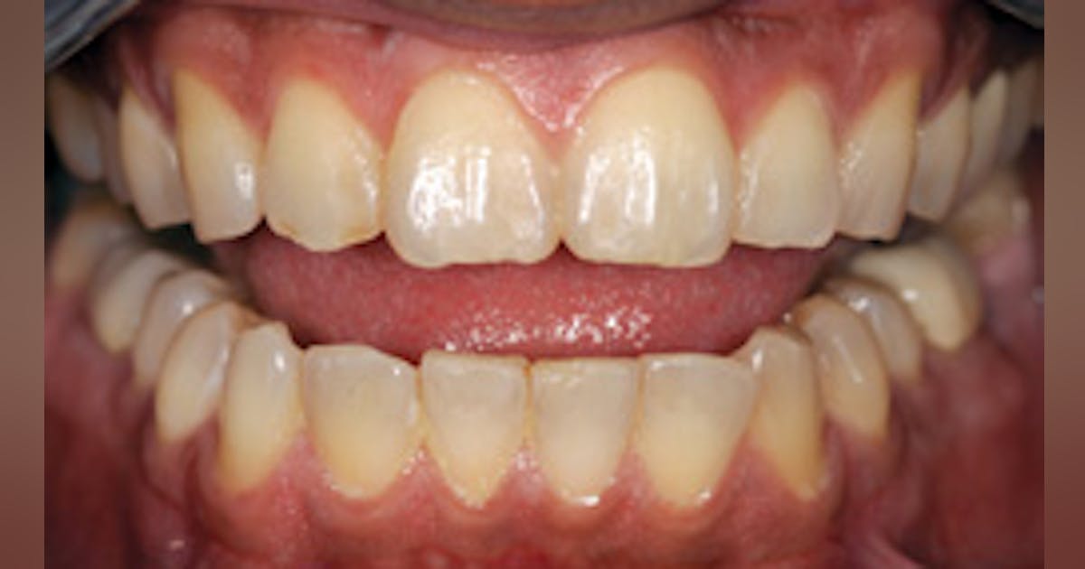 Tooth color modification: A discussion on the mechanism and options for ...